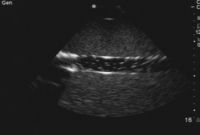 Pregnancy Ultrasound Report Sample with Investigation Of the Potential for Vascular Bubble formation In A